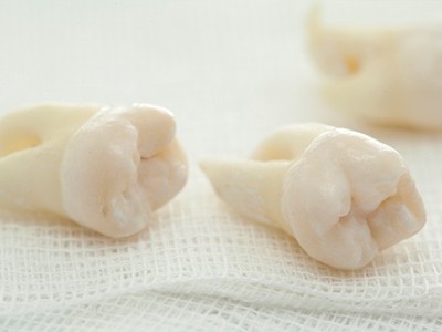 智齒疼了，這牙非拔不可嗎？