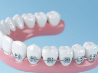 想做牙齒矯正，哪種方案更適合你？