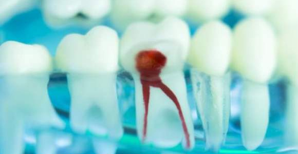 根管治療實現(xiàn)可視化操作