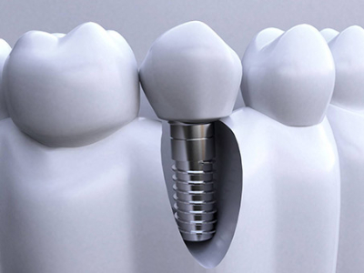 承德種植牙價(jià)格表，2024種植牙多少錢一顆呢?