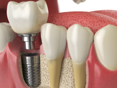 選擇種植牙后要做哪些日常維護？