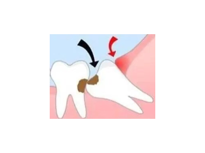 吃完飯后老塞牙？別大意！這可能是你的牙齒在報警