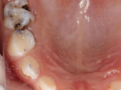 河北惟德口腔兒童涂氟，用專業(yè)守護(hù)孩子乳牙健康