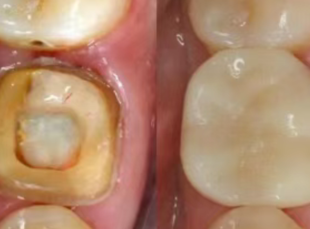 根管治療（抽神經(jīng)）后，為什么一定要做牙冠？