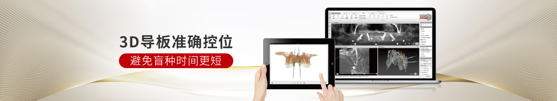 惟德口腔種植牙,3D導(dǎo)板準(zhǔn)確控位,避免盲種時間更短