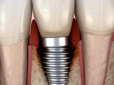種植牙的術(shù)前準備有哪些？