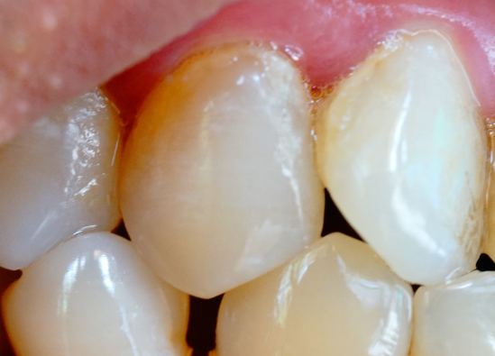 牙齒表面的牙釉質(zhì)掉了還可以修復嗎？