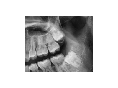 既然「智齒」不宜久留，為什么不能一次性拔掉？
