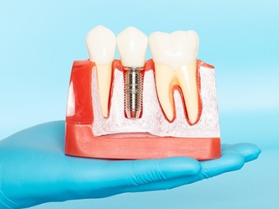 種牙VS鑲牙，你適合哪種?
