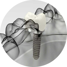 術(shù)前研究、模擬提升種植成功率