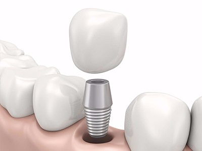 在承德哪家口腔醫(yī)院口腔種植齒好一點(diǎn)，惟德口腔醫(yī)院值得您的選擇