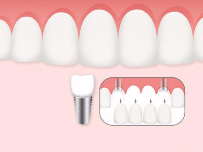 惟德口腔口腔種植怎么樣？惟德口腔就來為您一一解答