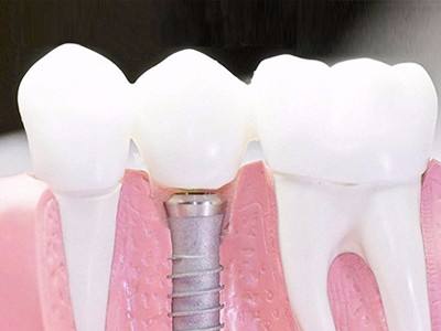 在承德口腔種植齒需要多少錢？惟德口腔一一為您道來(lái)