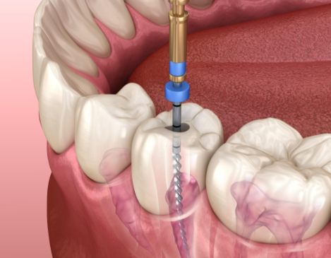 根管治療后的注意事項有哪些？