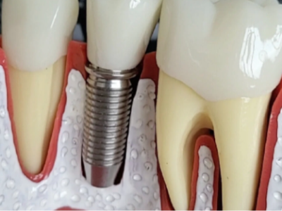 鷹手營子缺牙老人：惟德口腔全口種植牙越早做越輕松